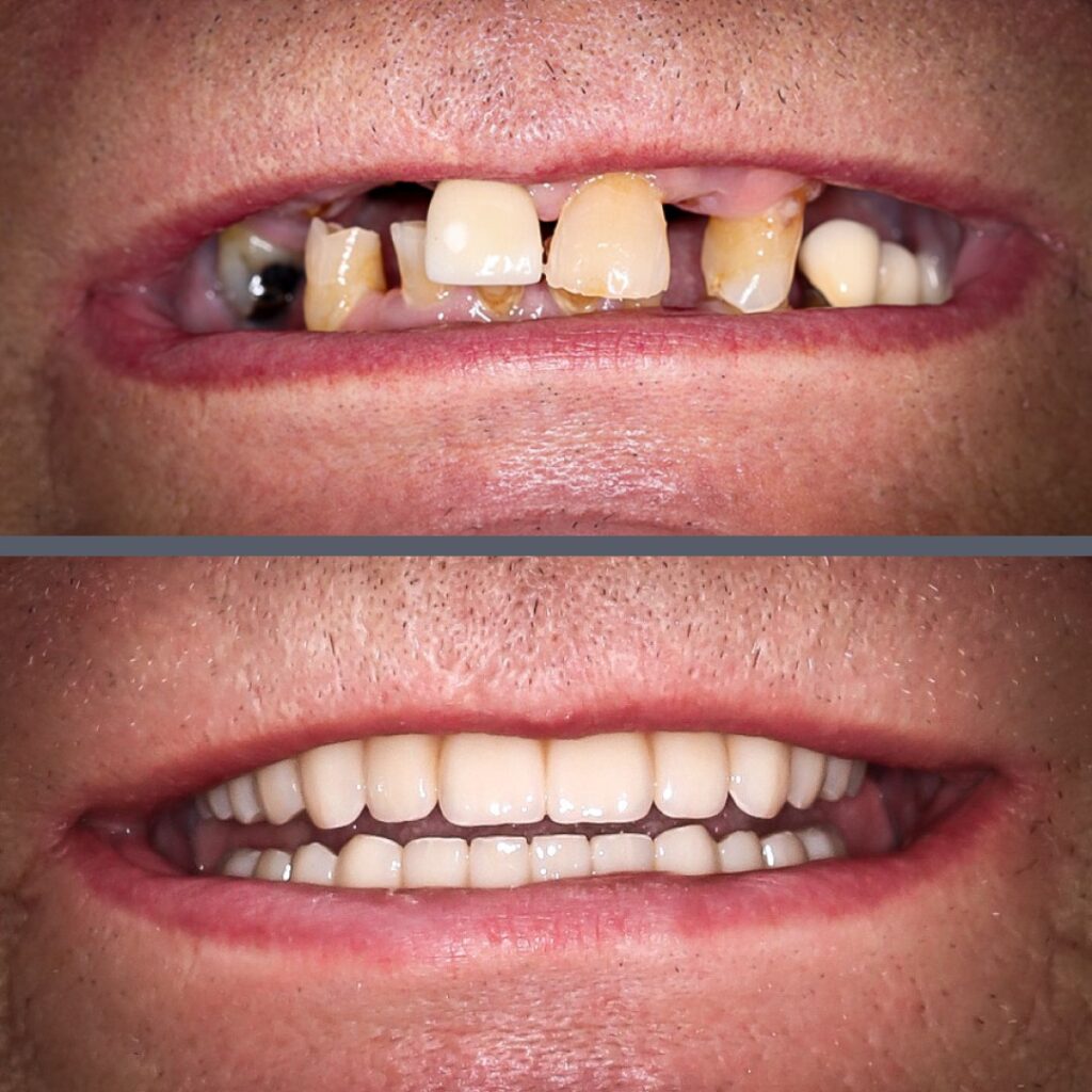 Periodontitt HELFO